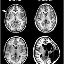 Brain Injury & Asbestos
